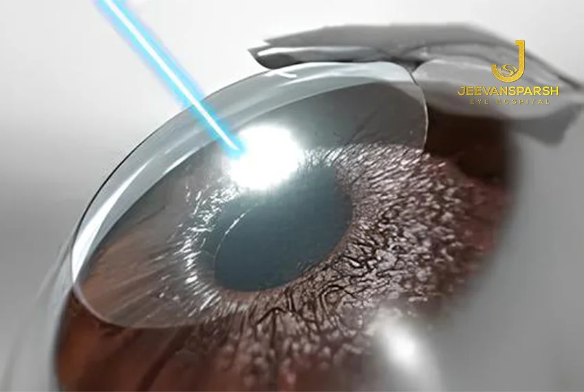 Success rate of lasik eye surgery in India: How Safe Is Eye Surgery In 2025?