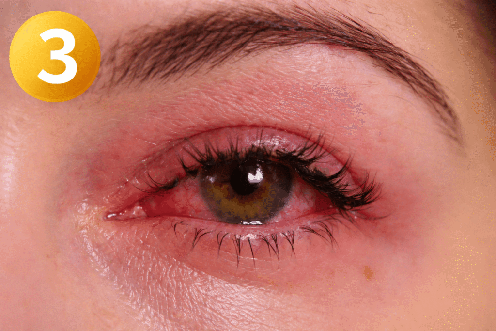 Redness & Tearing
