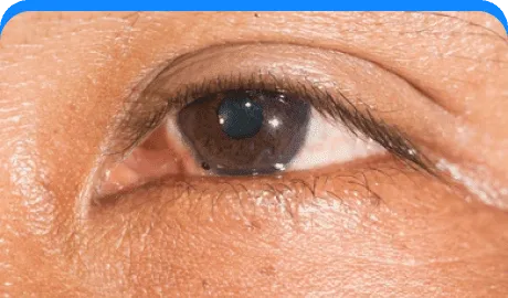 Orbital foreign body.png-Eye Hospital In Pune