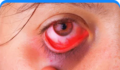 Orbital fractures.png-Eye Hospital In Pune