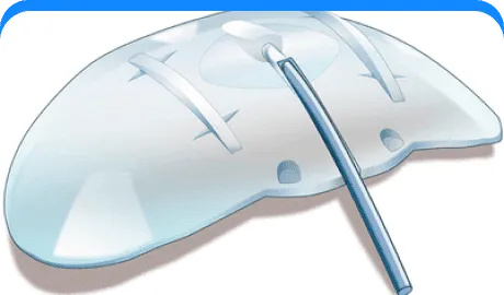 Glaucoma Drainage Devices