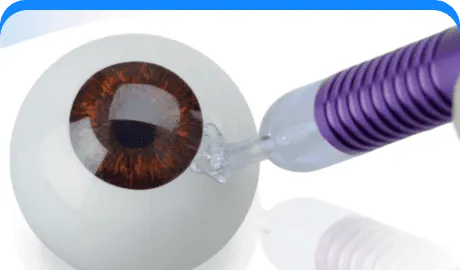 Micropulse Transscleral Cyclophotocoagulation (MP-TSCPC)